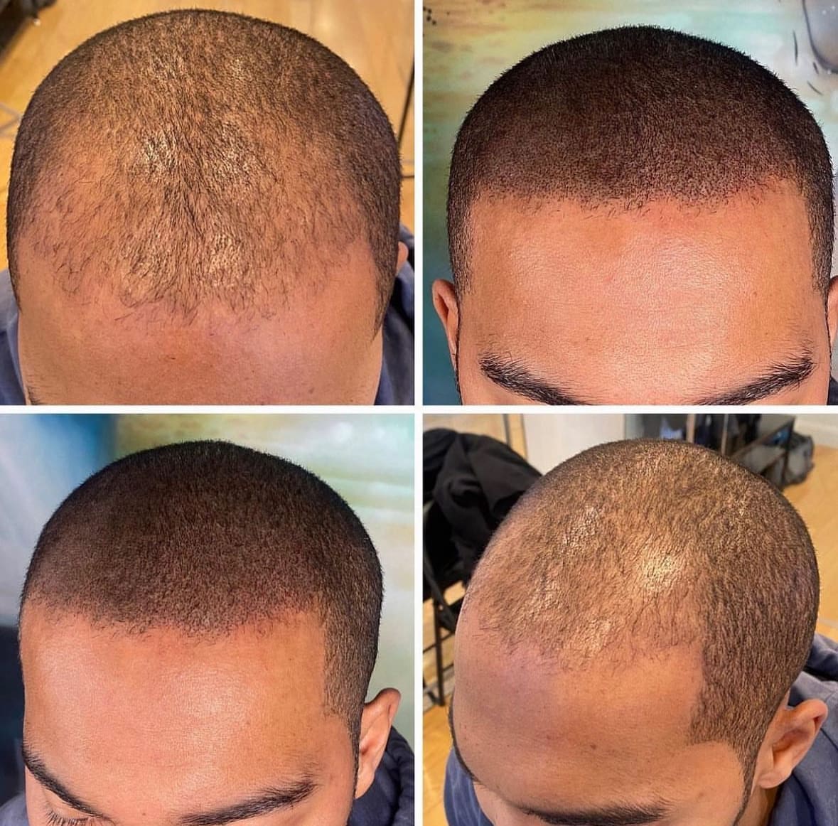 scalp micropigmentation density with hair transplant