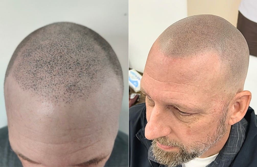 scalp micropigmentation gone wrong