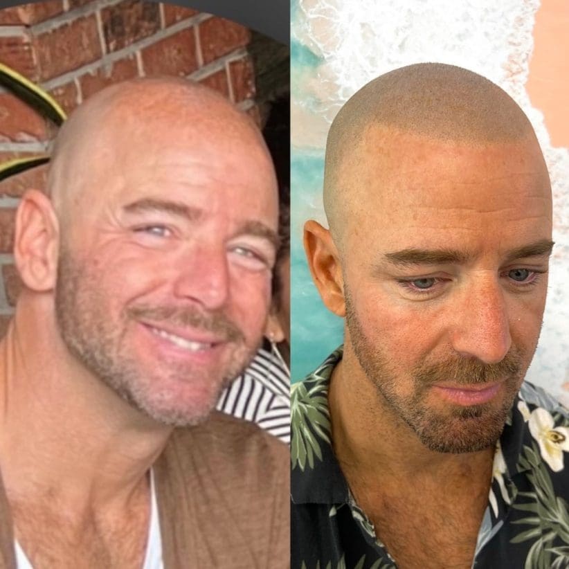 micropigmentation