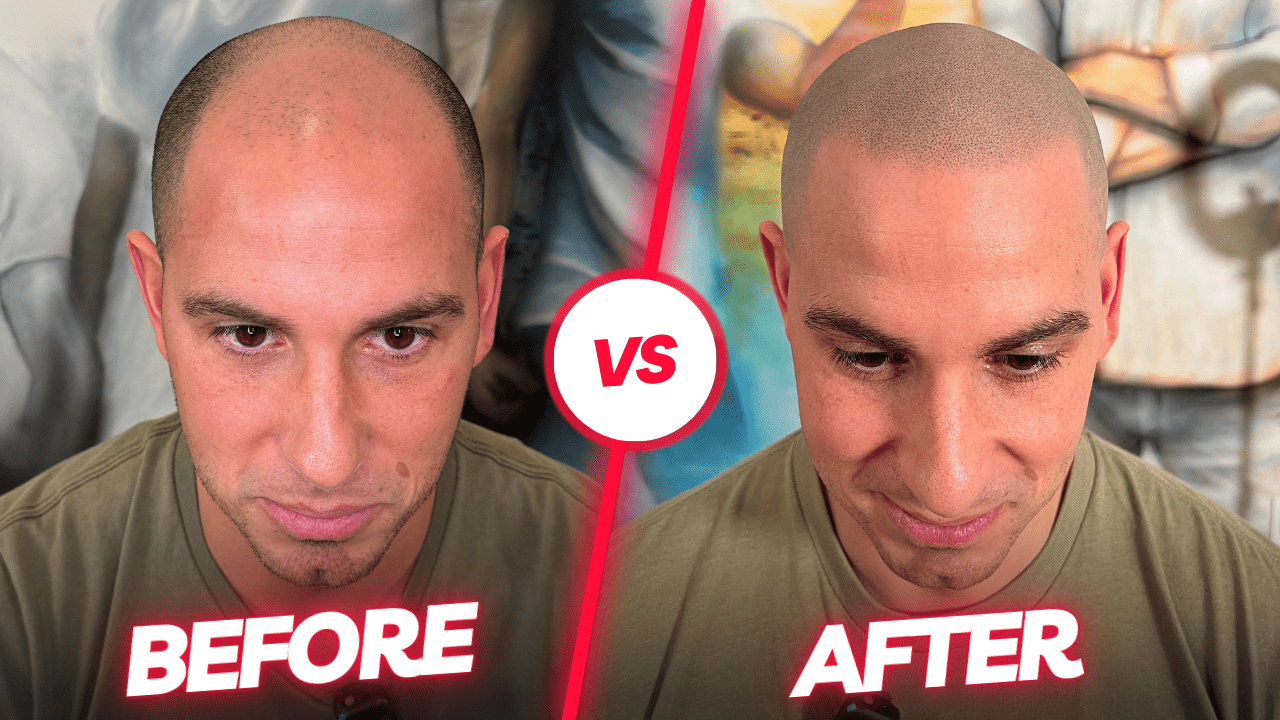 scalp micropigmentation